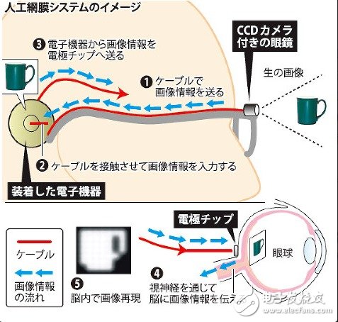 日本人工視網(wǎng)膜用電子芯片代替視網(wǎng)膜細(xì)胞發(fā)揮作用