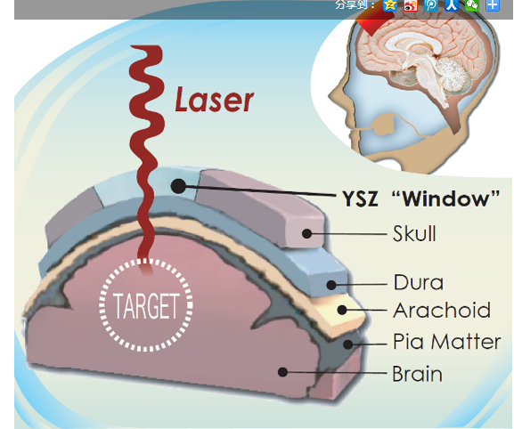 為頭骨打造出“可視窗戶”技術出爐，對大腦的監測更加高效